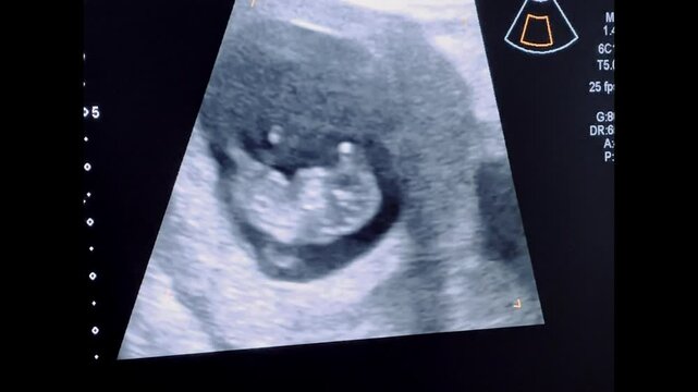 2D Ultrasound display of 10 weeks pregnant. Fetus ultrasound image that show important organs.