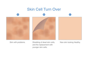 Skin with dark spots are peeled off from top skin surface to reveal new, younger looking skin after recovery. Skin cell turnover. Illustration about Exfoliation and scrub.