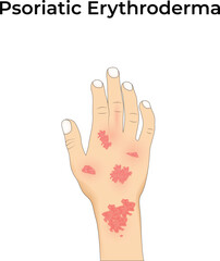 Psoriatic Erythroderma Design Vector Illustration
