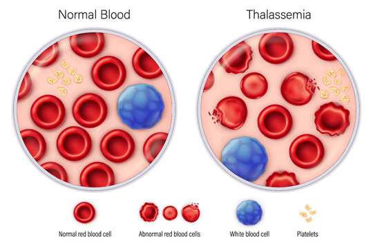 Comparison between normal blood and thalassemia vector. Blood smear. An inherited blood disorder. Medical education.