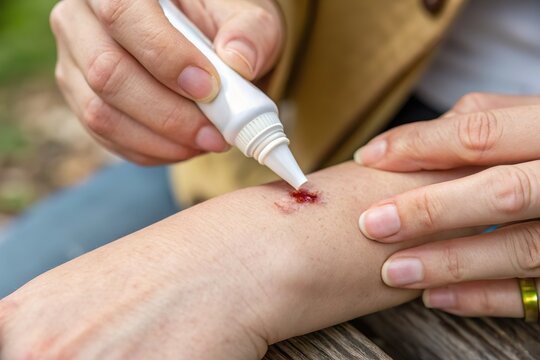 Hand apply antiseptic cream to wound. First aid and skin