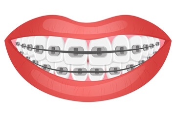 Vector image of mouth and teeth. Braces and bite correction. Dentistry and dental treatment concept. Element for your design of banners, posters, articles, etc.