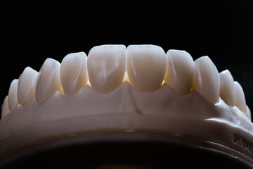 dental prosthetics veneers implant