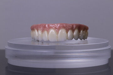 dental prosthetics veneers implant