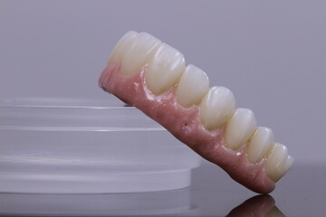 dental prosthetics veneers implant