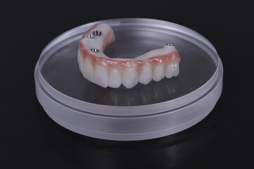 dental prosthesis veneers implant