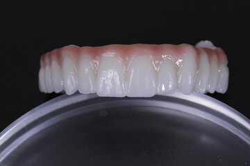 dental prosthetics veneers implant