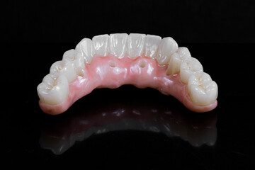 dental prosthetics veneers implant