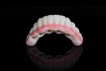 dental prosthetics veneers implant