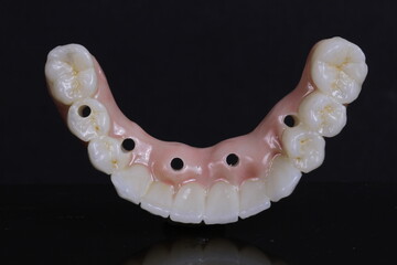 dental prosthesis veneers implant
