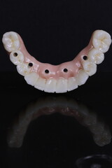 dental prosthesis veneers implant