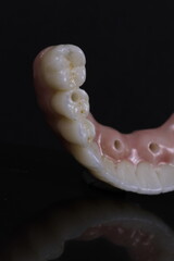 dental prosthesis veneers implant