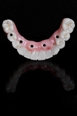 dental prosthesis veneers implant
