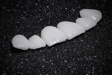 dental prosthesis veneers implant