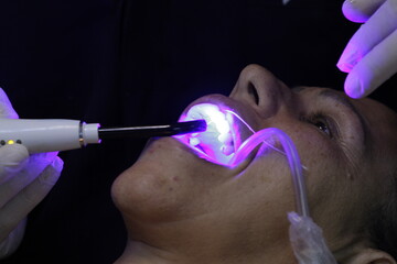 dental prosthesis veneers implant
