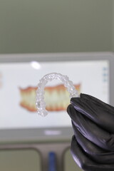 dental prosthesis veneers implant