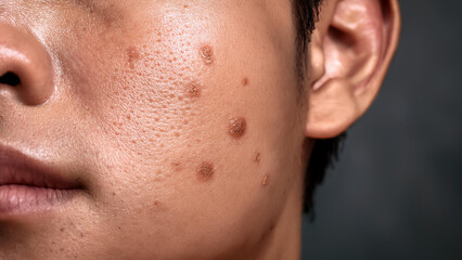 Facial Blemishes on Male Skin - Isolated Detail Shot for Skincare and Health Topics