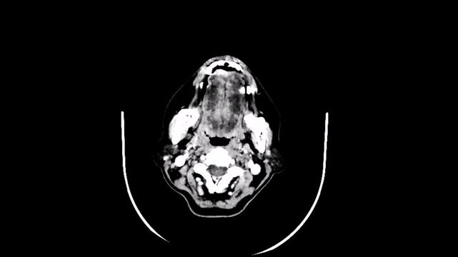 Axial computed tomography (CT) scan of the head showing an intra-axial tumour (lighter grey) in the brain's right frontal lobe.