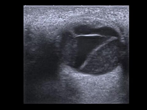 retinal detachment, and vitreus hemorrhage , ocular ultrasonography