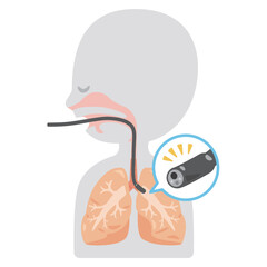 気管支鏡検査を受けるシンプルな人物の横顔イラスト