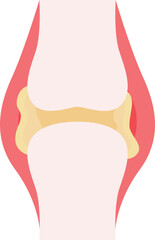 Naklejka premium Chronic Tophaceous Gout