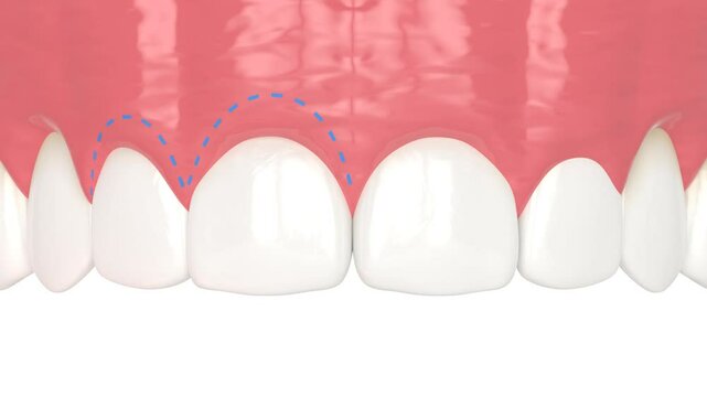 Upper jaw treated with laser for gummy smile. Creating a new gum line.