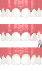3D rendering of the step-by-step procedure of laser treatment for gummy smile in the upper jaw and creation of a new gum line.