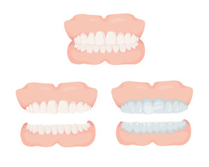 入れ歯セット-1