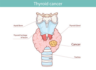 Obraz premium Thyroid cancer. Vector anatomical illustration hand drawn in cartoon style.
