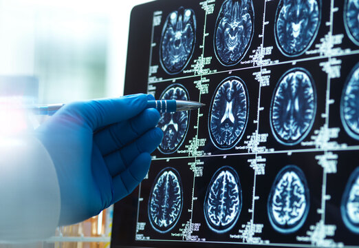 Doctor viewing  a brain scan for possible ageing and disease