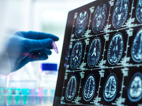 Dementia and Alzhiemer's Research, Scientist preparing human sample during a clinical trial