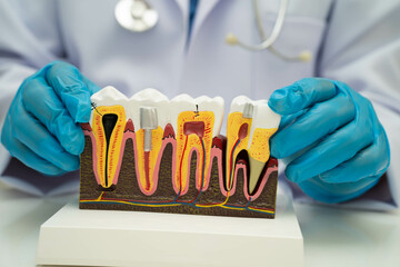 Dentist holding dental implant, artificial tooth roots into jaw, root canal of dental treatment,...