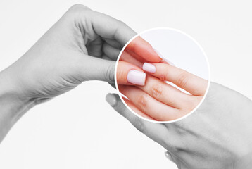 A woman has a wart on her little finger. Treatment of warts with liquid nitrogen.