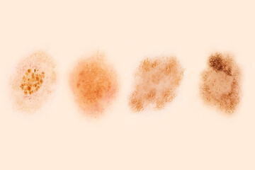 Pattern of normal pigmented nevi. Dermatoscopy. Magnified 20 times. Dermatological set.