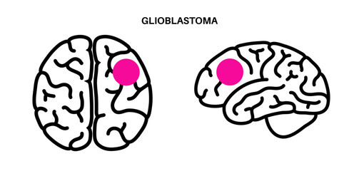Glioblastoma brain cancer