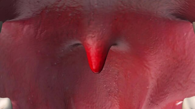 Close-Up of Swollen Uvula Inside Mouth