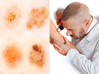 The doctor performs a dermatoscopy. Prevention of skin cancer. Pattern of normal skin nevi.