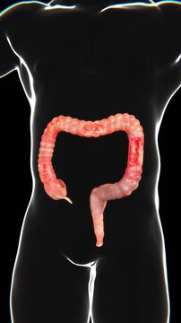 Crohn&rsquo;s Disease Indication Video | Crohn&rsquo;s Disease in Vertical HQ Video