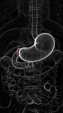 Duodenal Ulcers Indication Video | Ulcers in stomach in Vertical HQ Video