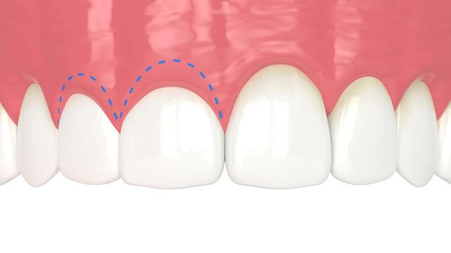 Upper jaw treated with laser for gummy smile. Creating a new gum line.