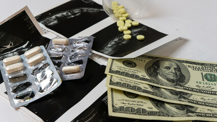 Ultrasound scans, medical pills, and US dollar bills are placed on a white table, symbolizing healthcare expenses and medical costs Close-up shot illustrating the financial aspect of medical treatment