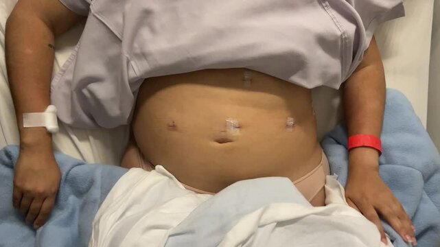 Real video of Woman&rsquo;s Abdomen with Laparoscopic Surgery Scars Post-Operation