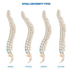 Set illustration of four spinal deformity types: normal spine, kyphosis, lordosis, and flat back. The image highlights the differences in curvature and alignment of the spine, providing a clear visual