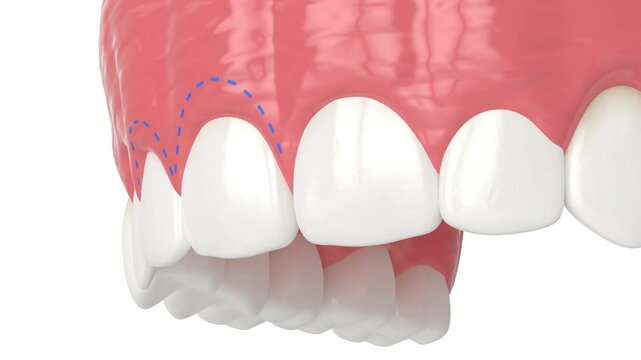 Upper jaw treated with laser for gummy smile. Creating a new gum line by gingivectomy.