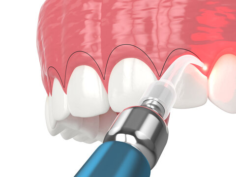 Upper jaw treated with laser for gummy smile. Creating a new gum line by gingivectomy.