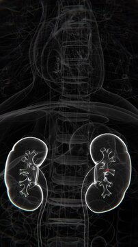 Kidney stones Indication X-Ray Video | kidney stones in Vertical HQ X-Ray Video