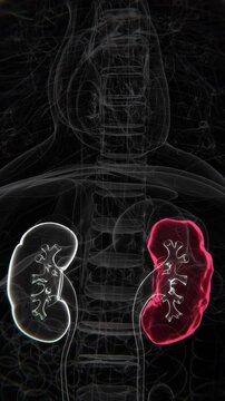 Polycystic Kidney Disease Indication Video | kidney damage in Vertical HQ Video