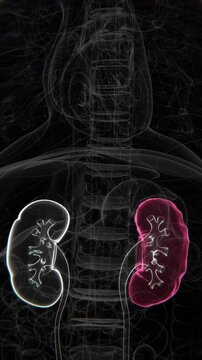 Polycystic Kidney Disease Indication X-ray Video | Kidney Damage in Vertical HQ X-ray Video