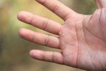 Hand Eczema on man hand with selective focus from being allergic reactions some chemical  oxidant