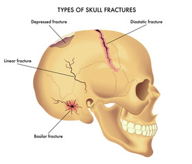 Medical illustration of types of skull fractures, with annotations.